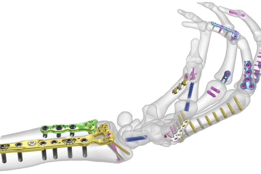 Acumed hand and wrist tool showing how it works on a reconstructed wrist and hand.