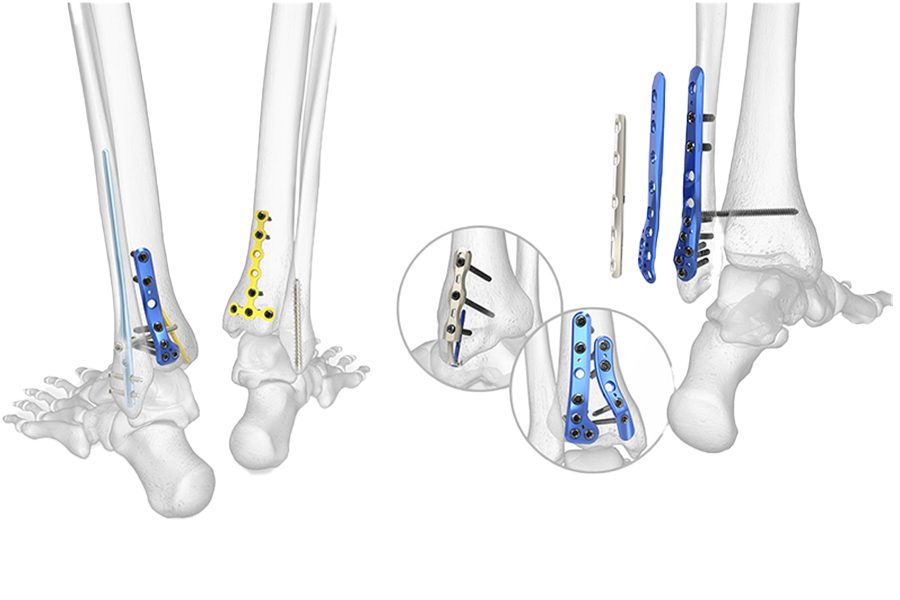 Acumed hand and wrist tool showing how it works on a reconstructed ankle